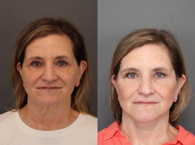 Facelifts Before & After Gallery - Patient 348592 - Image 1