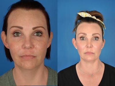 Facelifts Before & After Gallery - Patient 179379557 - Image 1