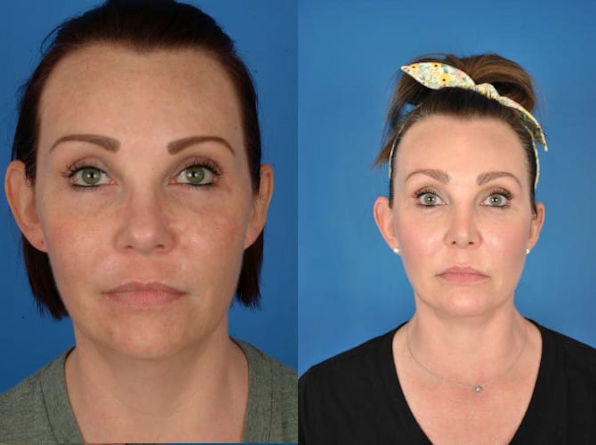 Facelifts Before & After Gallery - Patient 179379557 - Image 1