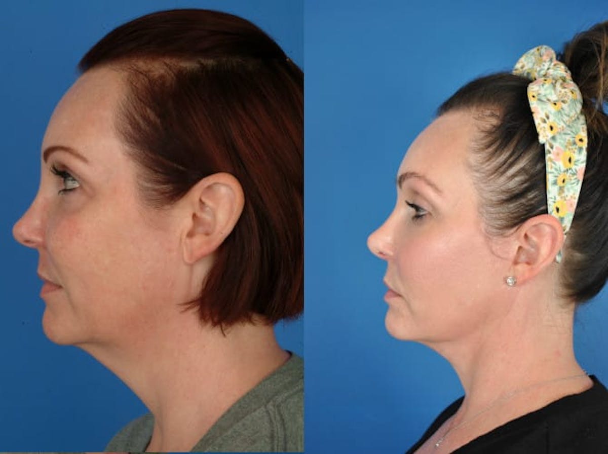 Facelifts Before & After Gallery - Patient 179379557 - Image 2