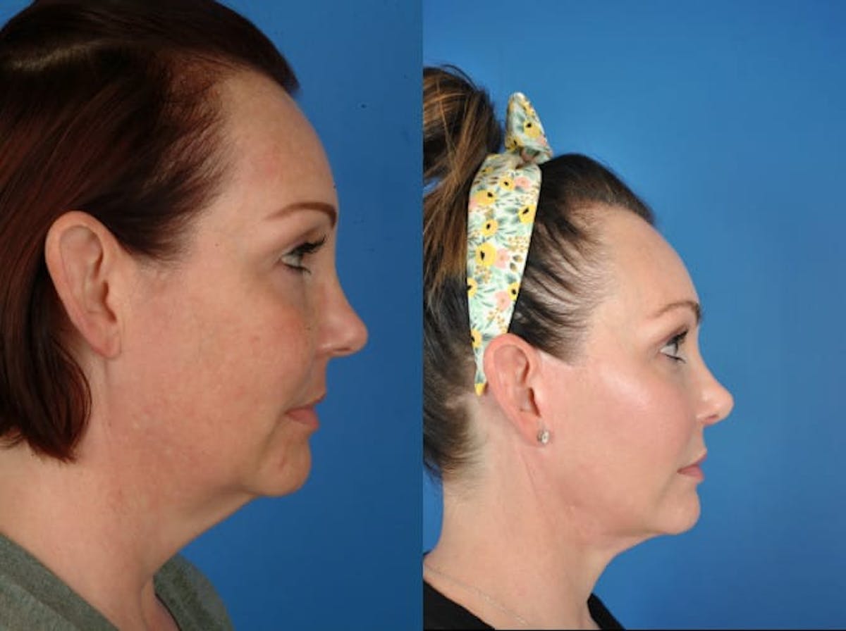 Facelifts Before & After Gallery - Patient 179379557 - Image 3
