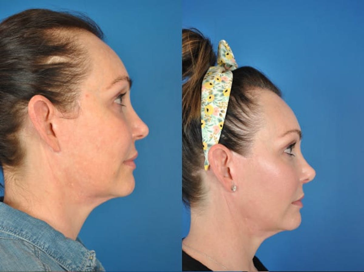 Rhinoplasty Before & After Gallery - Patient 179379610 - Image 2