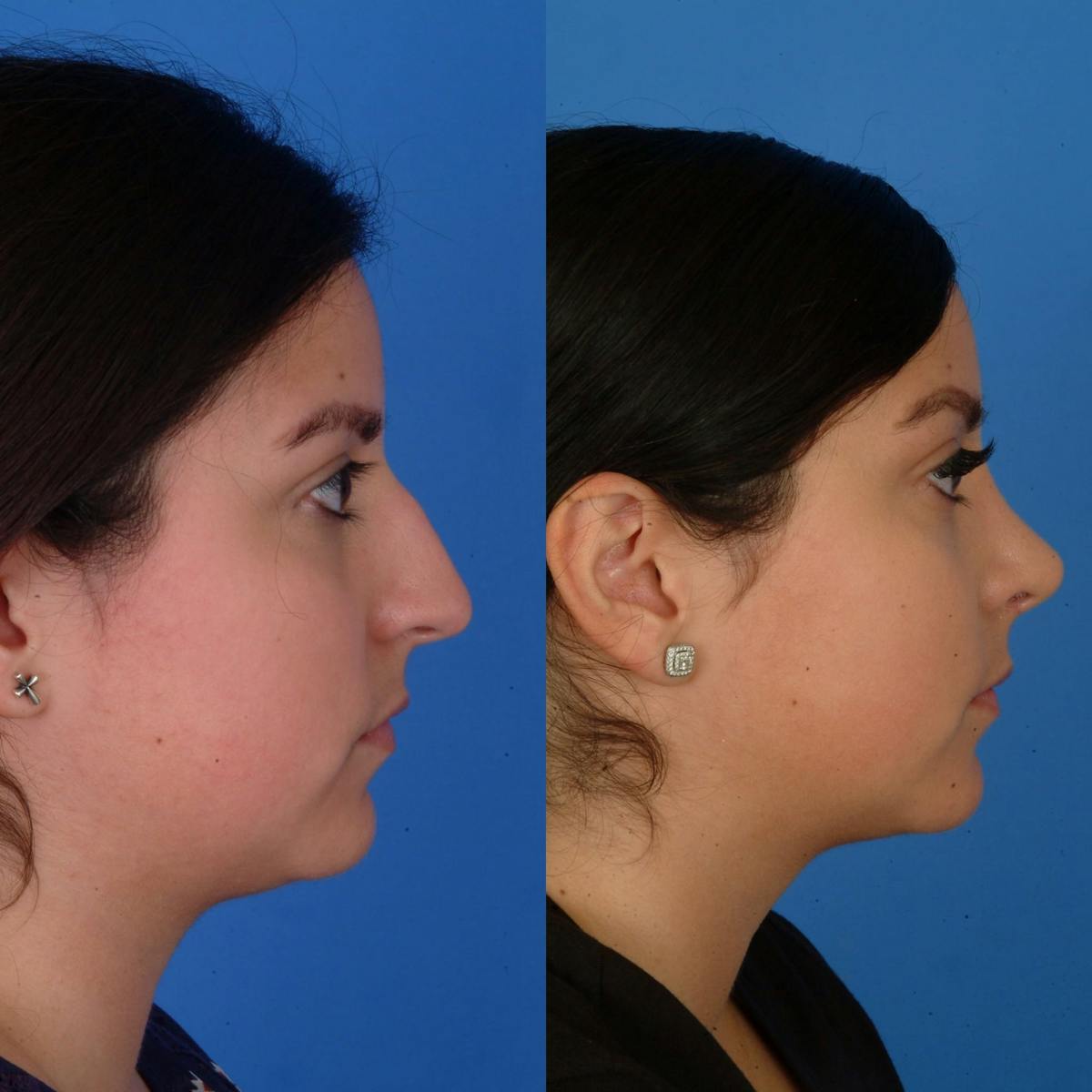 Rhinoplasty Before & After Gallery - Patient 179380168 - Image 1