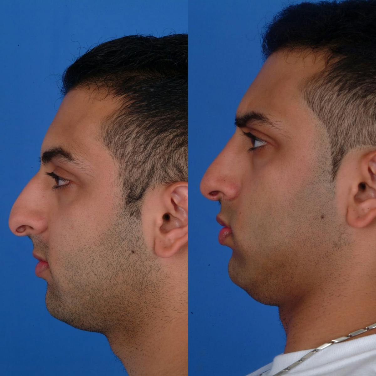 Rhinoplasty Before & After Gallery - Patient 179380169 - Image 1