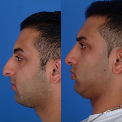 Rhinoplasty Before & After Gallery - Patient 179380169 - Image 1