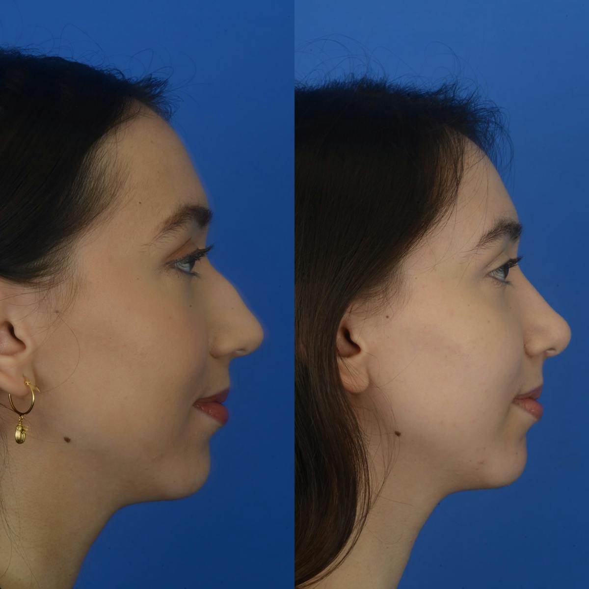 Rhinoplasty Before & After Gallery - Patient 179380207 - Image 2