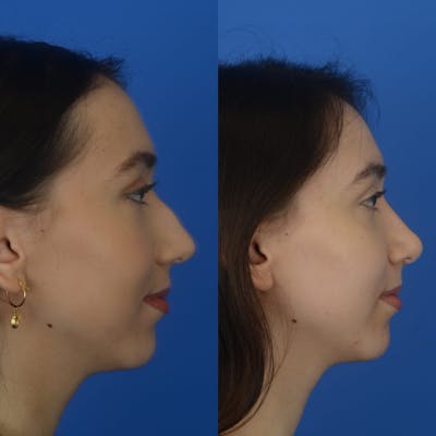 Rhinoplasty Before & After Gallery - Patient 179380207 - Image 1