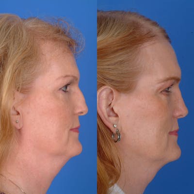 Rhinoplasty Before & After Gallery - Patient 179380217 - Image 1