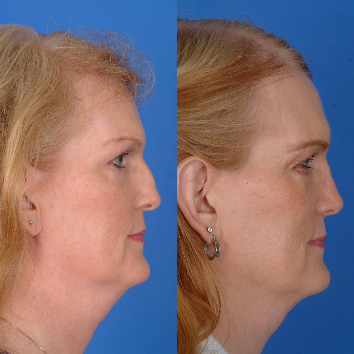 Rhinoplasty Before & After Gallery - Patient 179380217 - Image 1