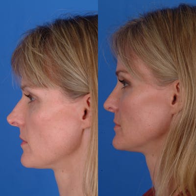 Rhinoplasty Before & After Gallery - Patient 179380263 - Image 1