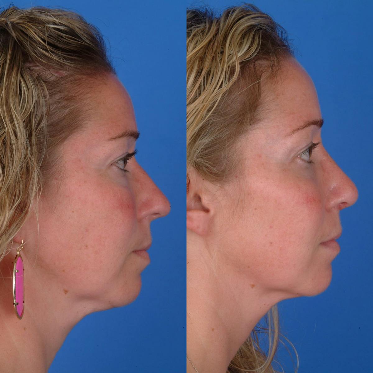 Rhinoplasty Before & After Gallery - Patient 179380264 - Image 1