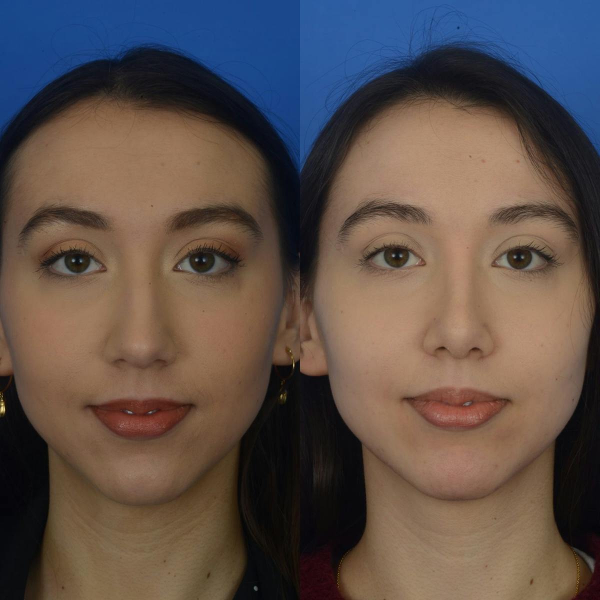 Rhinoplasty Before & After Gallery - Patient 179380207 - Image 1