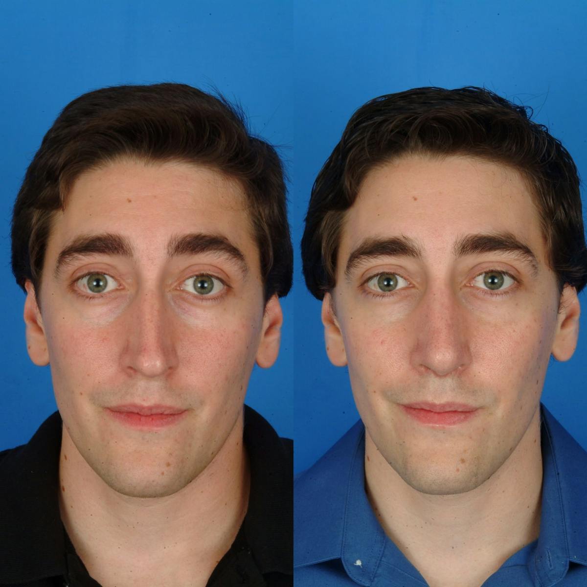 Rhinoplasty Before & After Gallery - Patient 179380268 - Image 1