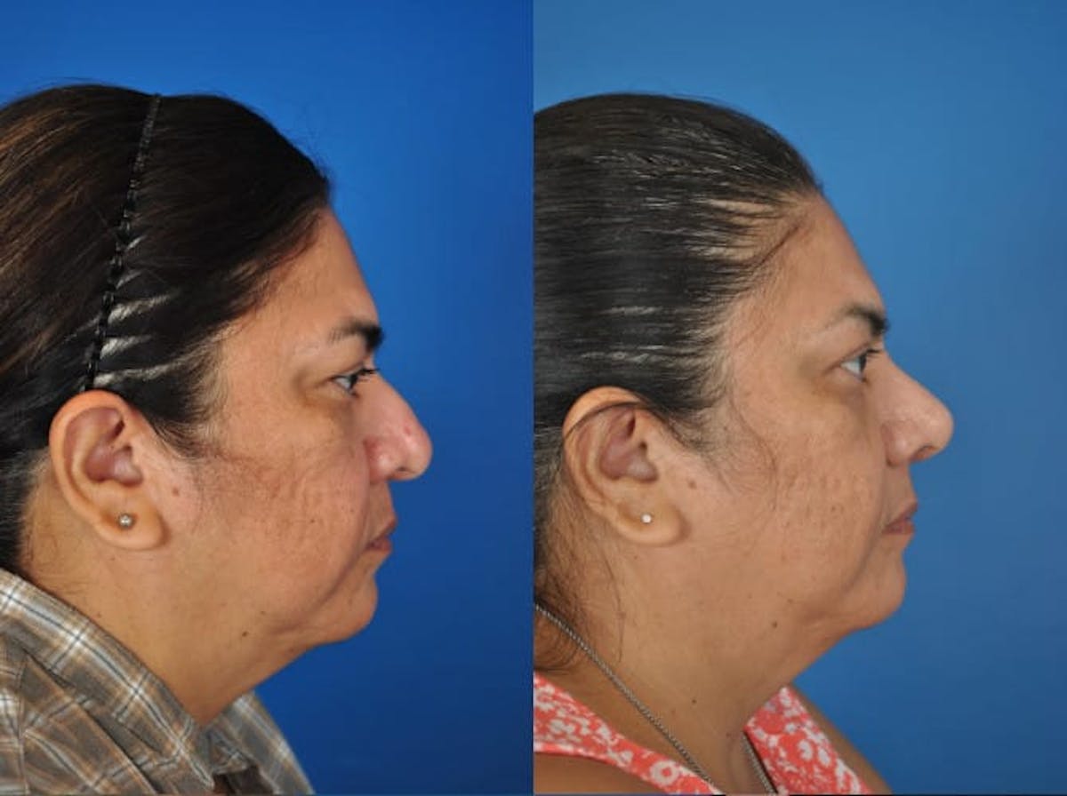 Rhinoplasty Before & After Gallery - Patient 179382007 - Image 1