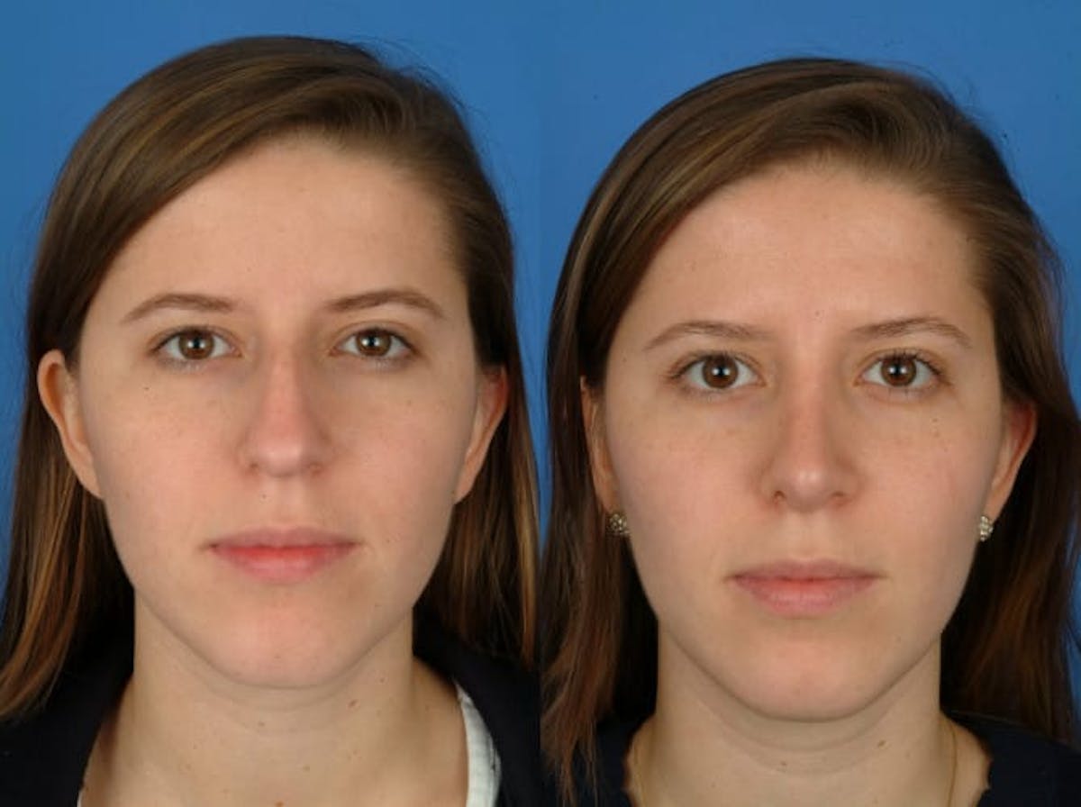 Rhinoplasty Before & After Gallery - Patient 179382096 - Image 2