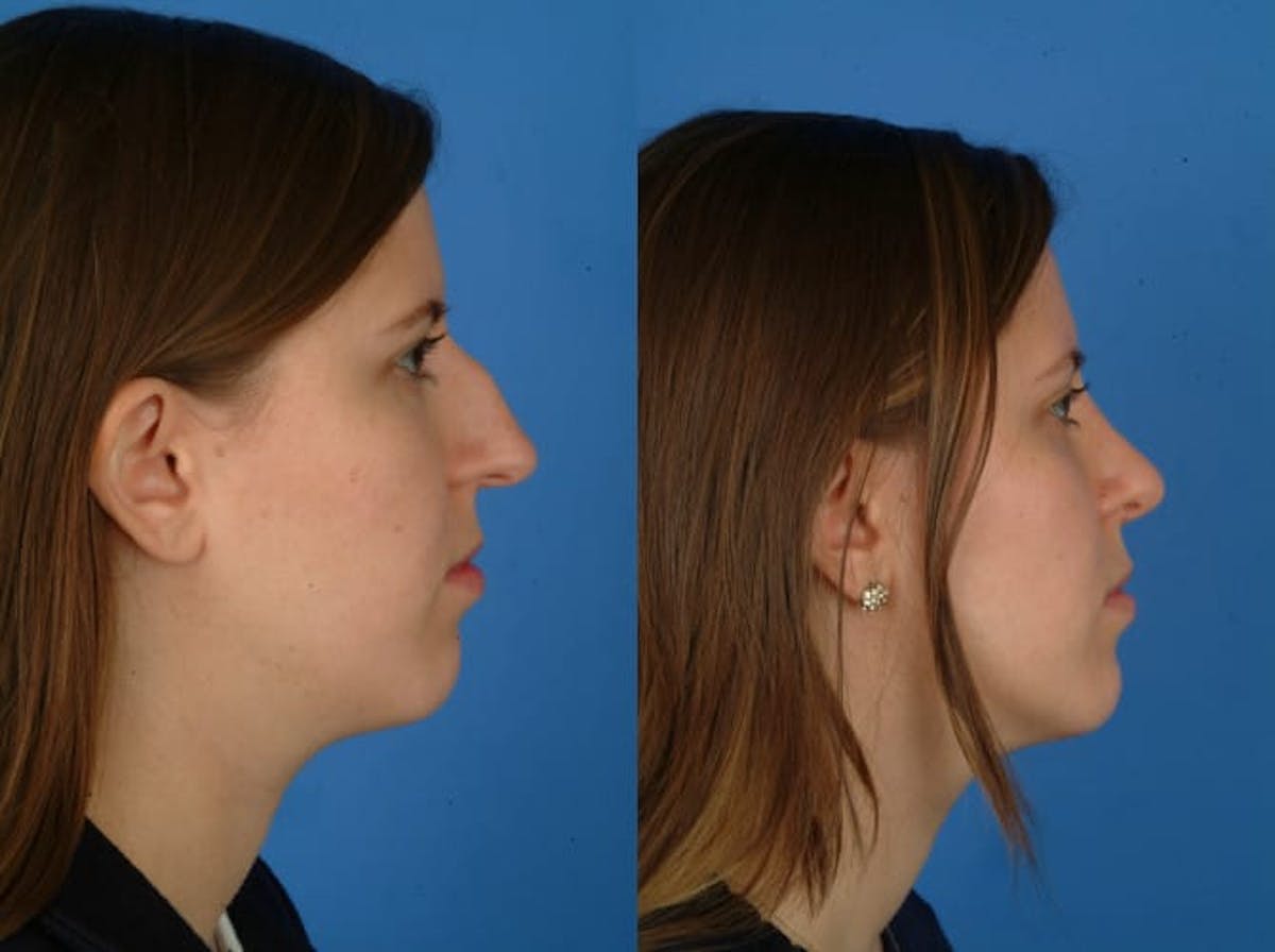 Rhinoplasty Before & After Gallery - Patient 179382096 - Image 1
