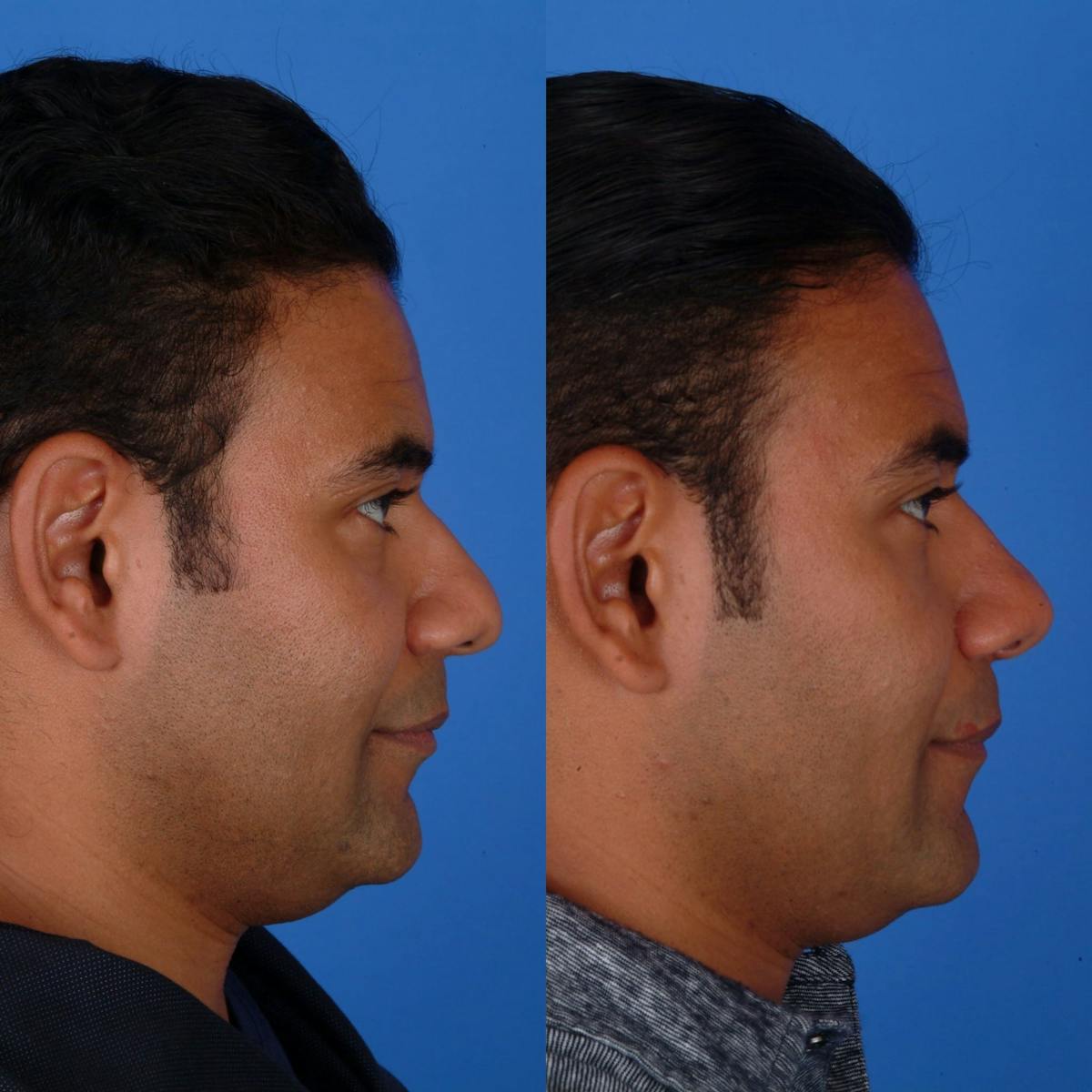 Rhinoplasty Before & After Gallery - Patient 179380666 - Image 1