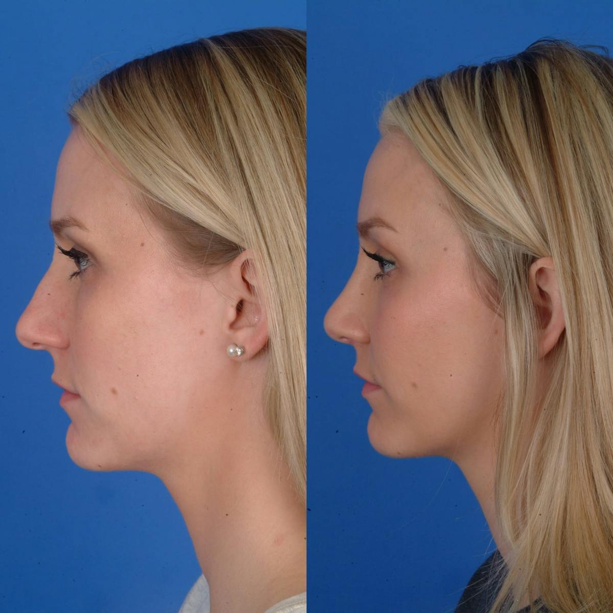 Rhinoplasty Before & After Gallery - Patient 179380725 - Image 1