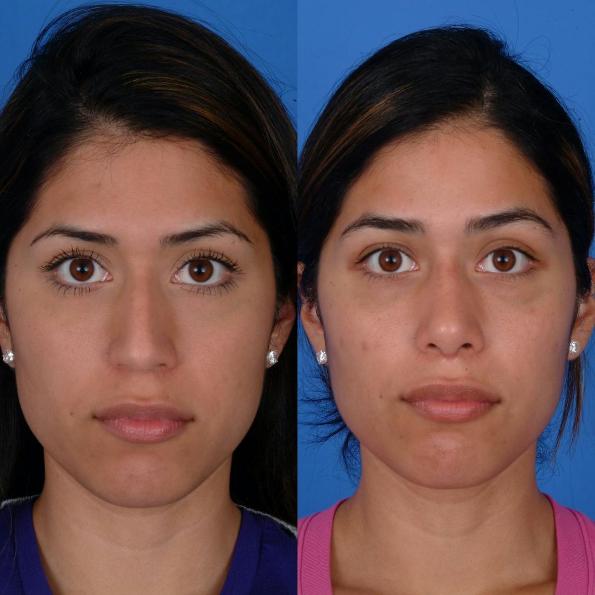 Rhinoplasty Before & After Gallery - Patient 179380789 - Image 1