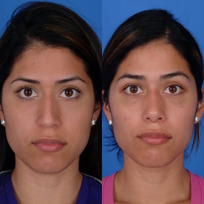 Rhinoplasty Before & After Gallery - Patient 179380789 - Image 1