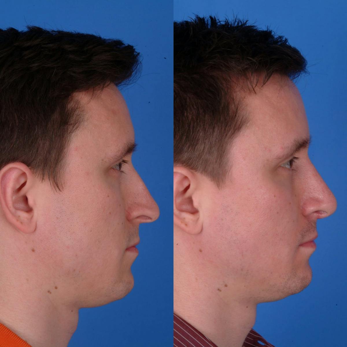 Rhinoplasty Before & After Gallery - Patient 179380790 - Image 1