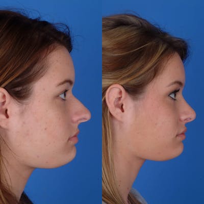 Rhinoplasty Before & After Gallery - Patient 179380791 - Image 1