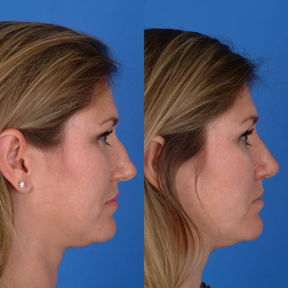Rhinoplasty Before & After Gallery - Patient 179380850 - Image 1