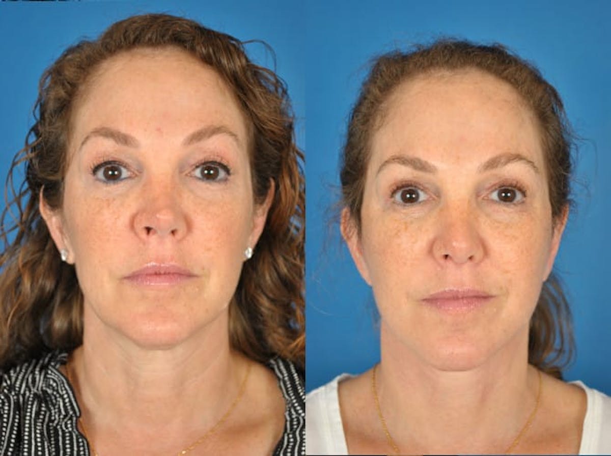 Facelifts Before & After Gallery - Patient 179381837 - Image 1