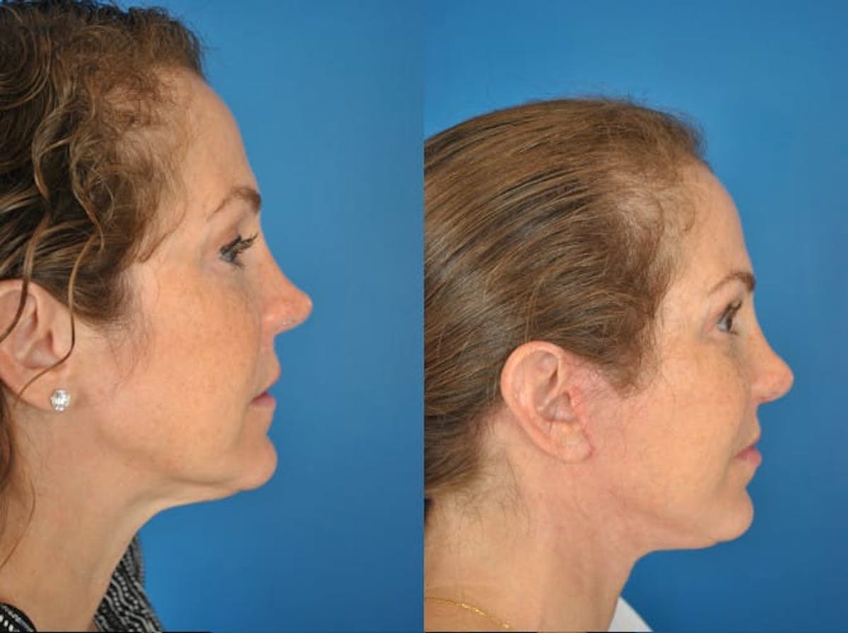 Facelifts Before & After Gallery - Patient 179381837 - Image 2