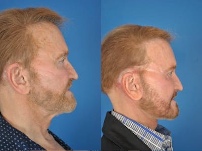 Facelifts Before & After Gallery - Patient 179382305 - Image 1