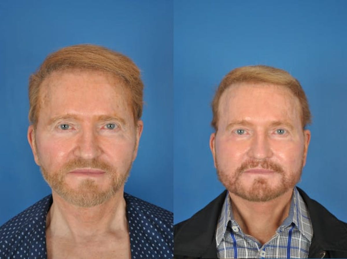Facelifts Before & After Gallery - Patient 179382305 - Image 2