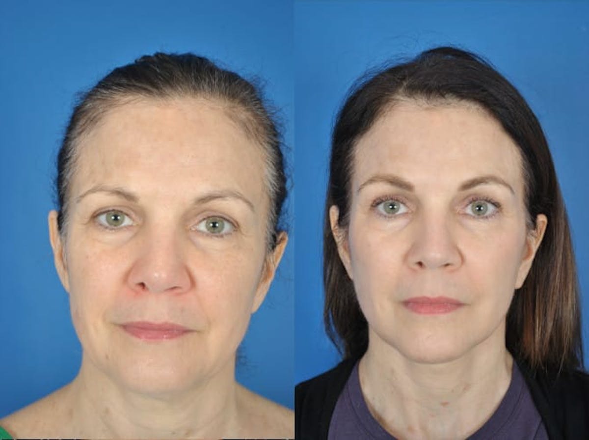 Facelifts Before & After Gallery - Patient 179382938 - Image 1