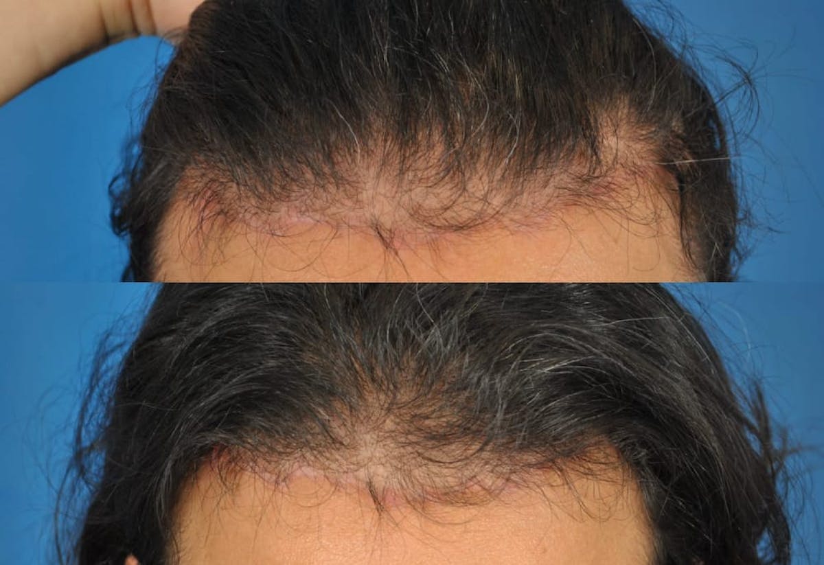 Hair Restoration Before & After Gallery - Patient 179383472 - Image 1