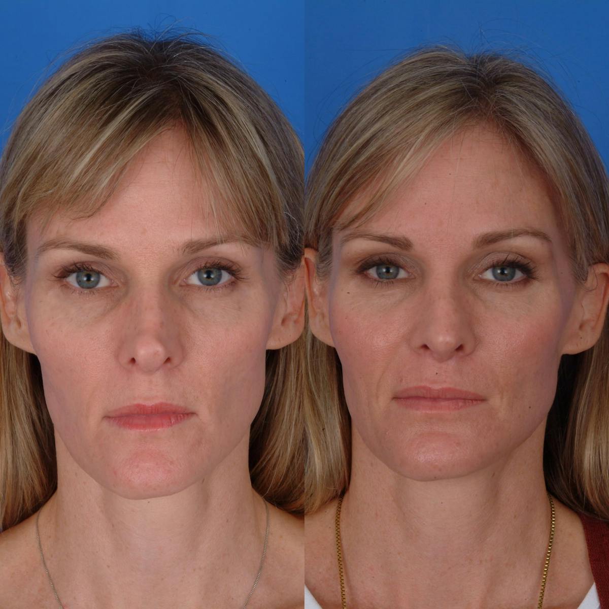 Rhinoplasty Before & After Gallery - Patient 179380263 - Image 2