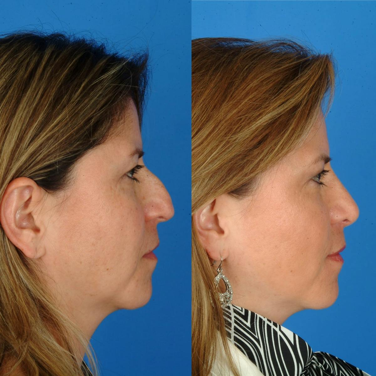 Rhinoplasty Before & After Gallery - Patient 179434067 - Image 1