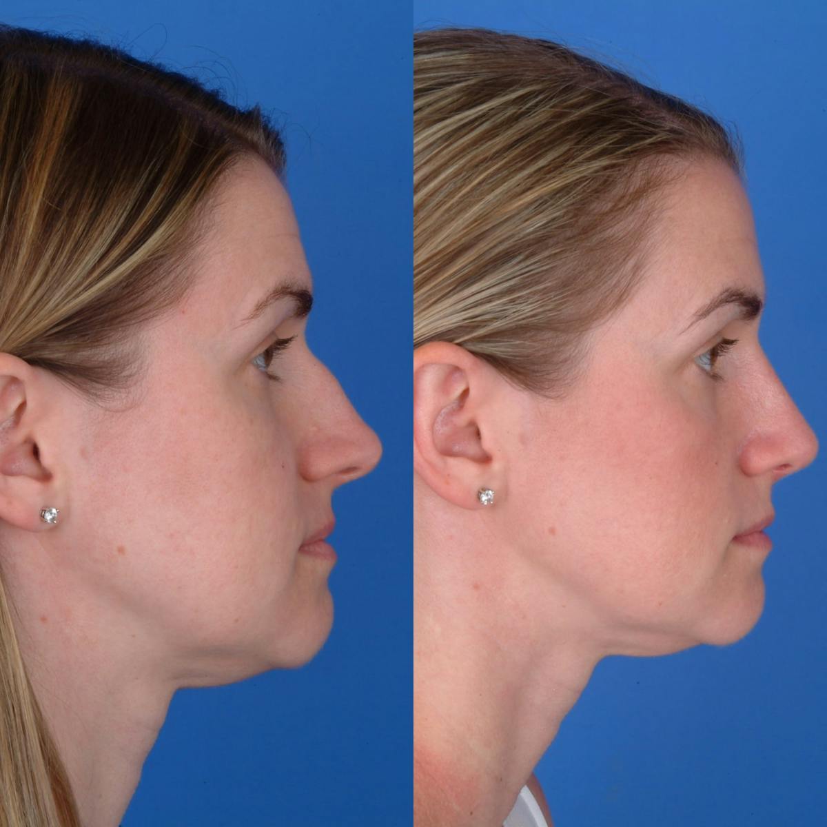 Rhinoplasty Before & After Gallery - Patient 179434068 - Image 1