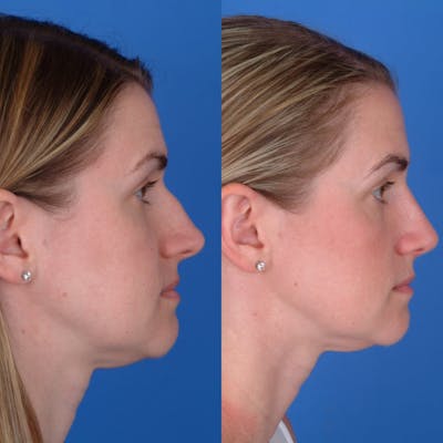 Rhinoplasty Before & After Gallery - Patient 179434068 - Image 1