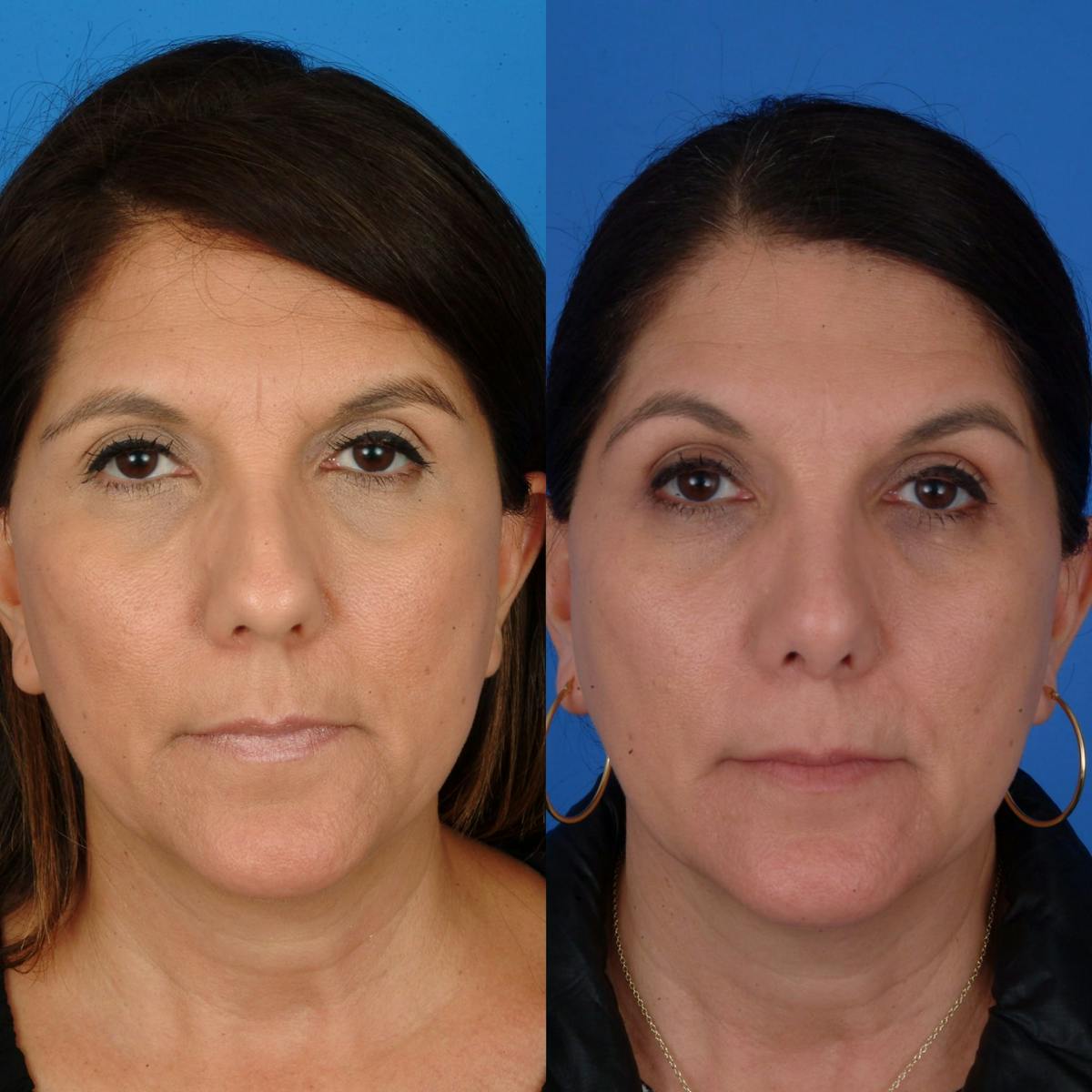 Rhinoplasty Before & After Gallery - Patient 179434069 - Image 2