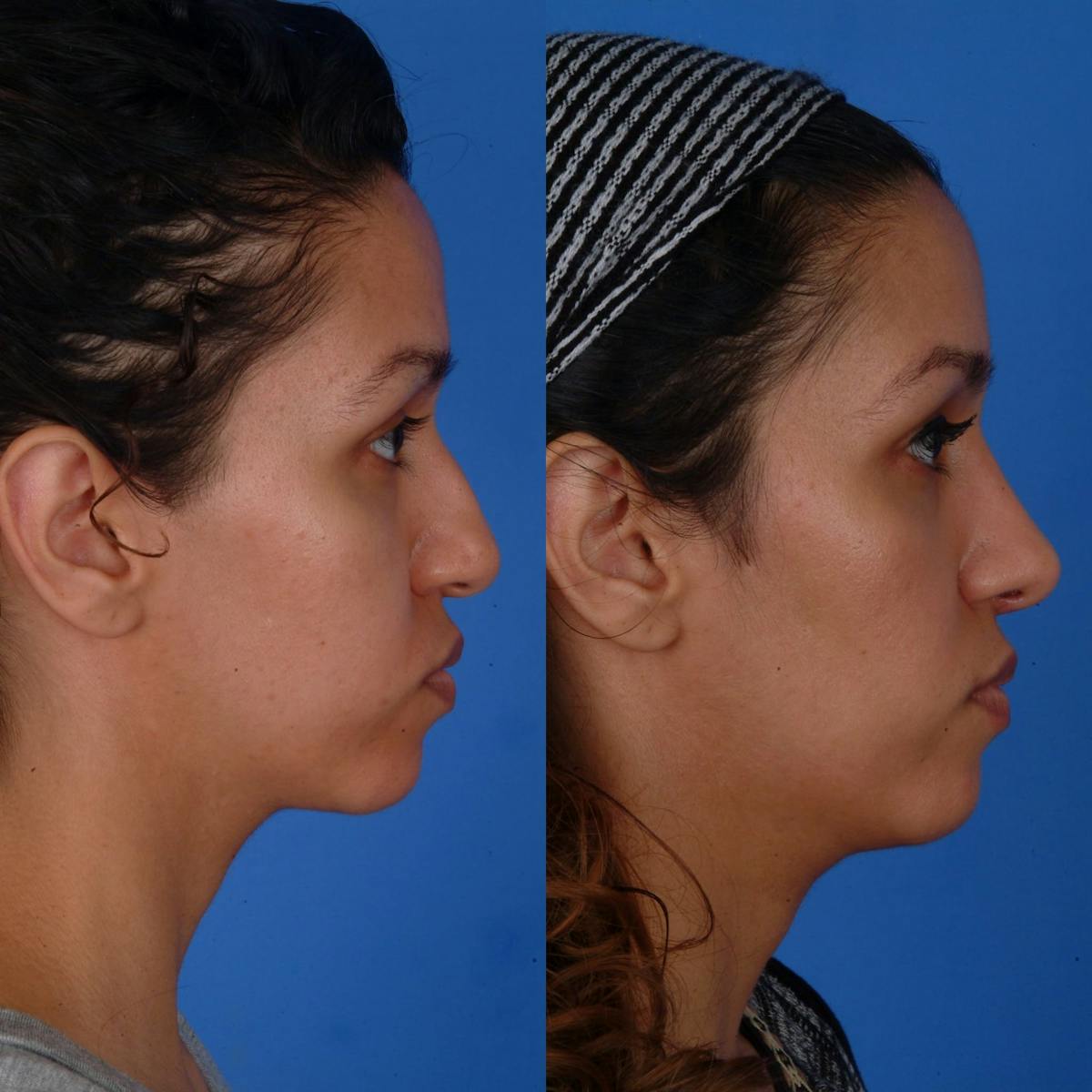 Rhinoplasty Before & After Gallery - Patient 179434070 - Image 1