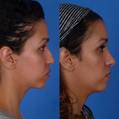 Rhinoplasty Before & After Gallery - Patient 179434070 - Image 1