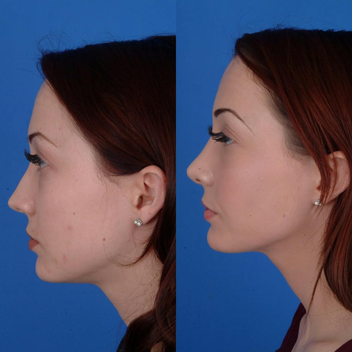 Rhinoplasty Before & After Gallery - Patient 179506500 - Image 2