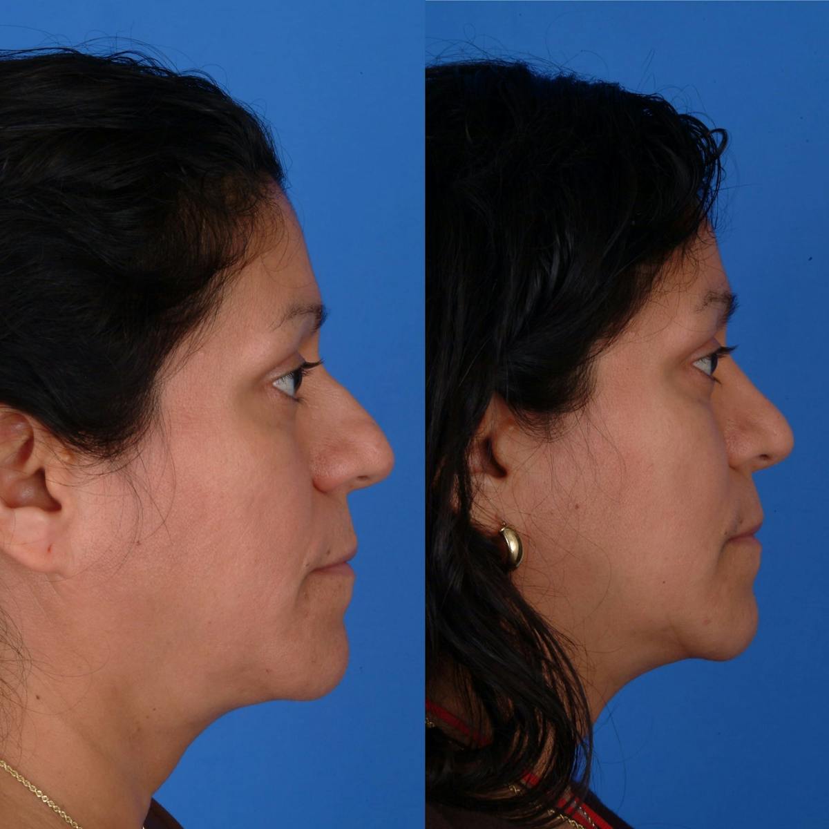 Rhinoplasty Before & After Gallery - Patient 179381372 - Image 1
