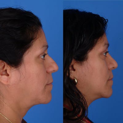 Rhinoplasty Before & After Gallery - Patient 179381372 - Image 1