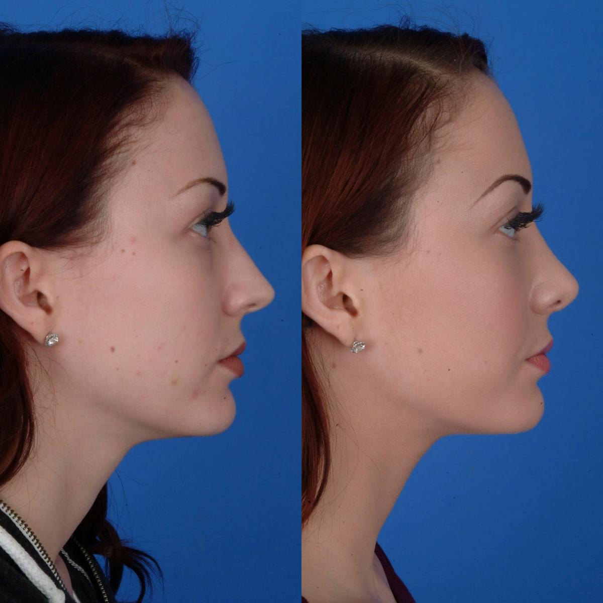 Rhinoplasty Before & After Gallery - Patient 179506500 - Image 1