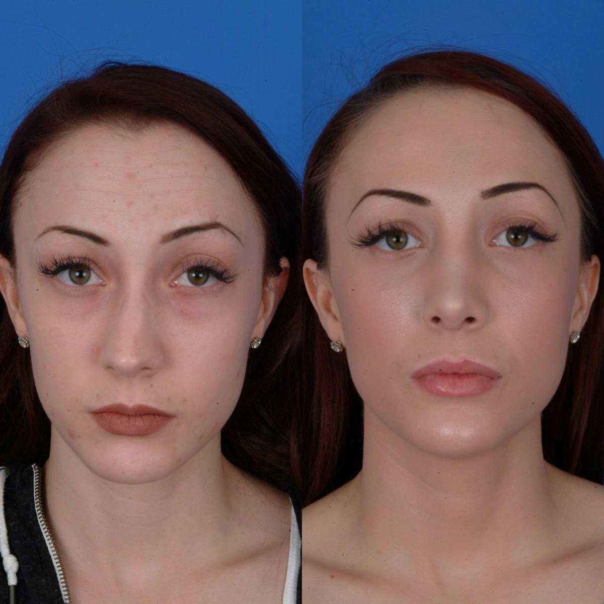 Rhinoplasty Before & After Gallery - Patient 179506500 - Image 3