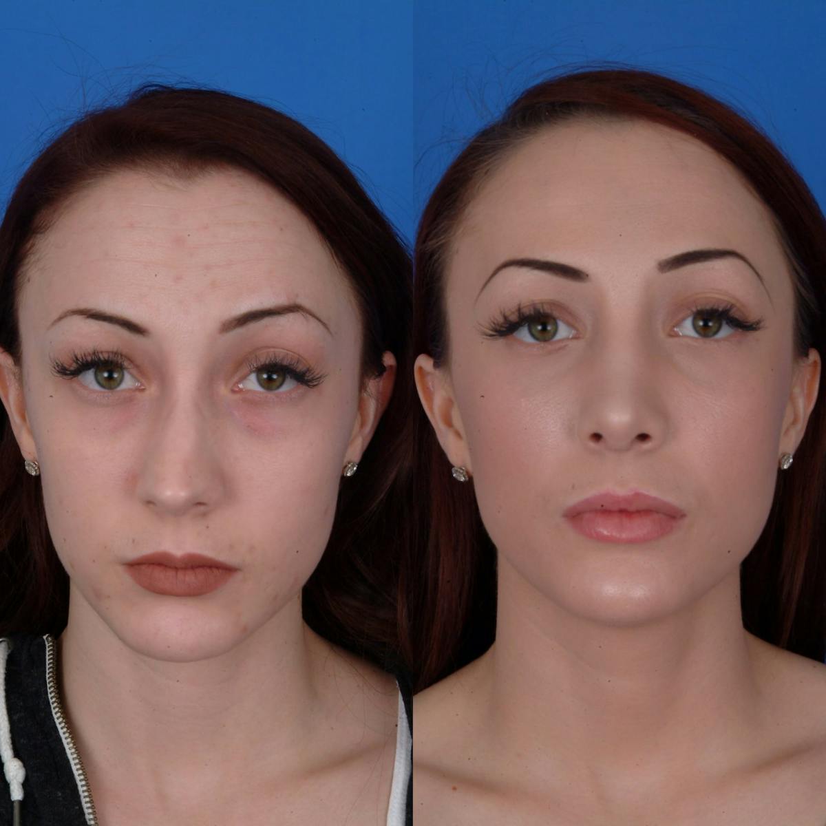 Rhinoplasty Before & After Gallery - Patient 179506500 - Image 1