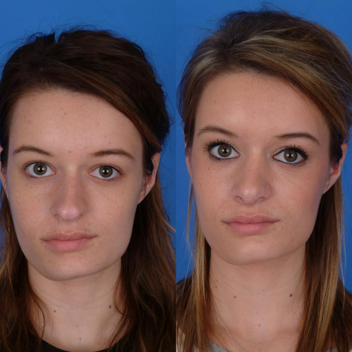 Rhinoplasty Before & After Gallery - Patient 179380791 - Image 2