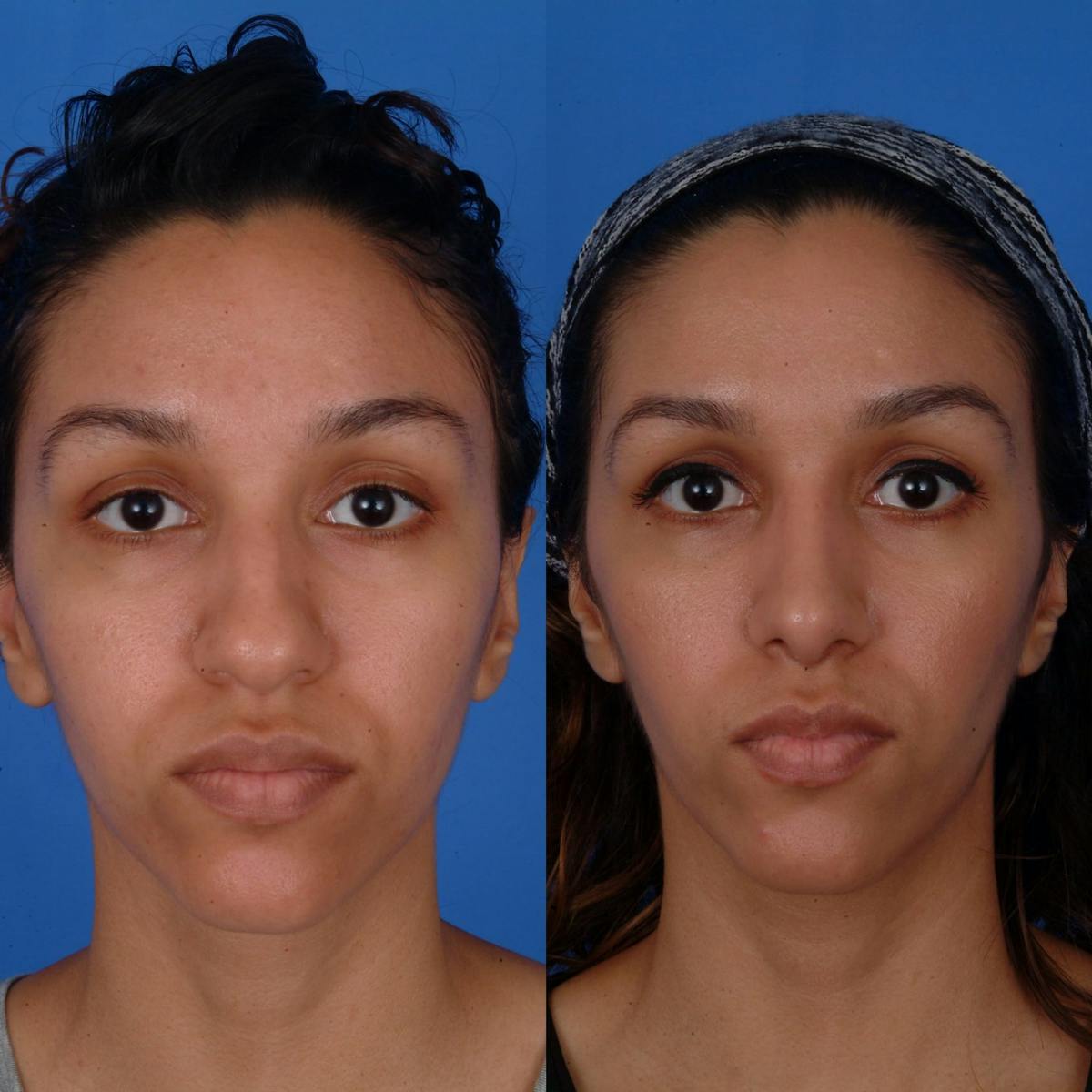 Rhinoplasty Before & After Gallery - Patient 179434070 - Image 2