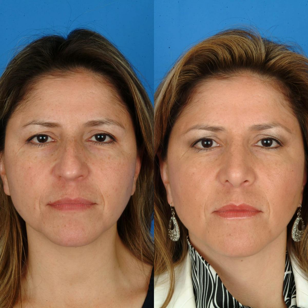 Rhinoplasty Before & After Gallery - Patient 179434067 - Image 2