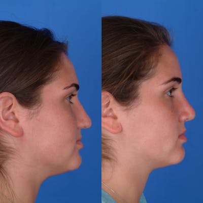 Rhinoplasty Before & After Gallery - Patient 179507136 - Image 1